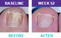 Patient 2 before and after results