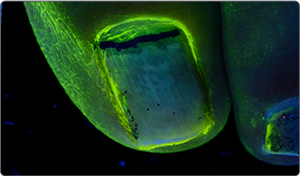 UV light after application 1