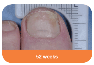 Diabetes toe at 52 weeks