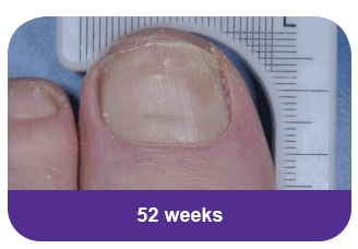 Diabetes toe at 52 weeks
