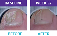 Patient 1 before and after results