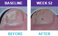 Patient 1 before and after results