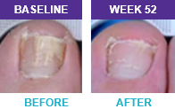 Patient 2 before and after results