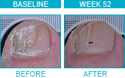 Patient 1 before and after results