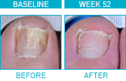 Patient 2 before and after results