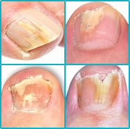 Symptoms of toenail fungus disease severity